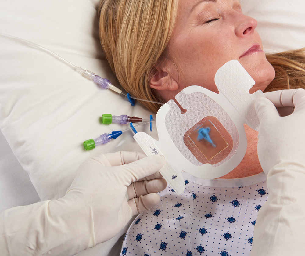 Tegaderm™ CHG krytí snižuje riziko extraluminální kontaminace